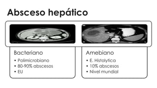 Absceso hepático
Bacteriano
• Polimicrobiano
• 80-90% abscesos
• EU
Amebiano
• E. Histolytica
• 10% abscesos
• Nivel mundial
 