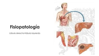Fisiopatología
Lóbulo derecho>lóbulo izquierdo
 