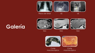 Galería
Placa de tórax US US
TAC TAC TAC
Corte
macroscópico
Corte
macroscópico
 