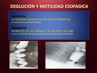 DIAGNOSTICO: 
Las radiografías realizadas en el momento de la ingestión de 
un medio de contraste (bario). 
TRATAMIENTO: 
Nitroglicerina por vía sublingual o los de acción más larga, 
como el dinitrato de isosorbide vía oral y antes de las comidas) 
 