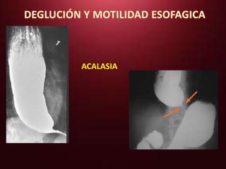 ACALASIA 
 