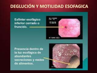 Absceso intraabdominal