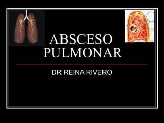 ABSCESO 
PULMONAR 
DR REINA RIVERO 
 