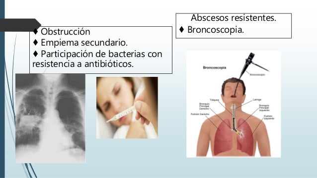 Resultado de imagen para drenaje de absceso pulmonar