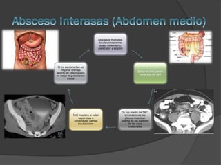 Abscesos múltiples,
loculaciones entre
asas, mesenterio,
pared abd y epiplón

Si no se conectan es
mejor el drenaje
abierto de otra manera
es mejor el percutáneo
inicial

TAC muestra si están
separadas o
conectadas ciertas
loculaciones

Estos no incluyen la
parte sup del abd

Dx por medio de TAC,
en ocasiones las
placas muestran
edema de las paredes
de las asas
intestinales

 