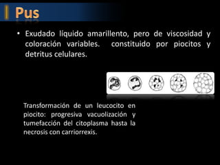 • Exudado líquido amarillento, pero de viscosidad y
  coloración variables. constituido por piocitos y
  detritus celulares.




 Transformación de un leucocito en
 piocito: progresiva vacuolización y
 tumefacción del citoplasma hasta la
 necrosis con carriorrexis.
 