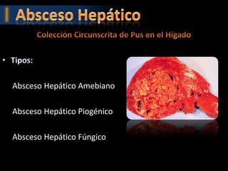 Absceso Hepático Amebiano

Absceso Hepático Piogénico

Absceso Hepático Fúngico
 