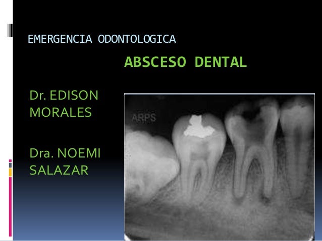 abscesos dentales absceso dental