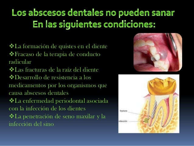 abscesos dentales absceso dental