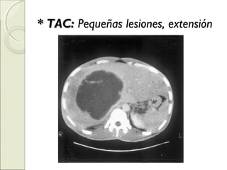 * TAC:* TAC: Pequeñas lesiones, extensión
 