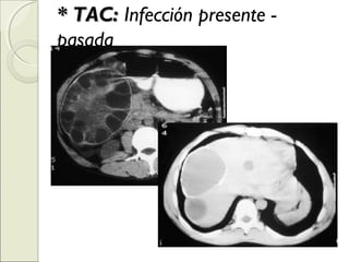 * TAC:* TAC: Infección presente -
pasada
 