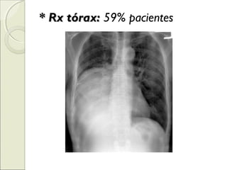 * Rx tórax:* Rx tórax: 59% pacientes
 