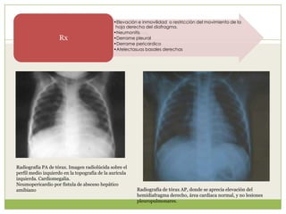 •Elevación e inmovilidad o restricción del movimiento de la
hoja derecha del diafragma.
•Neumonitis
•Derrame pleural
•Derrame pericardico
•Atelectasuas basales derechas
Rx
Radiografía de tórax AP, donde se aprecia elevación del
hemidiafragma derecho, área cardiaca normal, y no lesiones
pleuropulmonares.
Radiografía PA de tórax. Imagen radiolúcida sobre el
perfil medio izquierdo en la topografía de la aurícula
izquierda. Cardiomegalia.
Neumopericardio por fístula de absceso hepático
amibiano
 