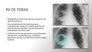 RX DE TORAX
• Radiografía de tórax (vista PA) de un paciente con
absceso pulmonar
• Una cavidad grande de paredes gruesas
(superposición verde) en la región perihiliar del
pulmón derecho contiene un nivel hidroaéreo
(indicado por una línea roja).
• El diferencial de esta apariencia incluye abscesos
(bacterianos, micobacterianos, micóticos),
granuloma cavitario no infeccioso y lesión maligna
cavitaria.
 