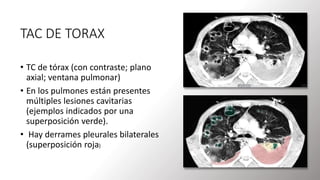 TAC DE TORAX
• TC de tórax (con contraste; plano
axial; ventana pulmonar)
• En los pulmones están presentes
múltiples lesiones cavitarias
(ejemplos indicados por una
superposición verde).
• Hay derrames pleurales bilaterales
(superposición roja)
 