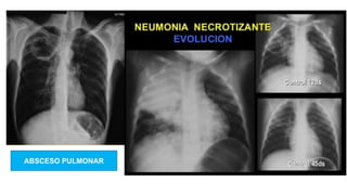 ABSCESO PULMONAR
 