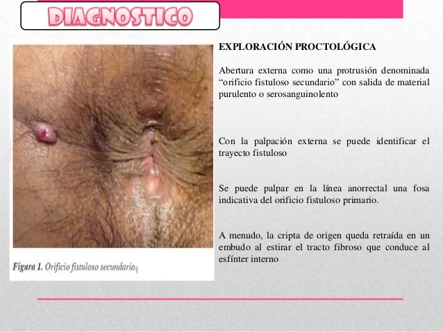 Resultado de imagen para fistulas anales