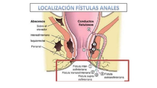 Resultado de imagen para fistulas anales