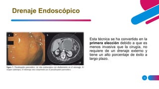 16
Drenaje Endoscópico
Esta técnica se ha convertido en la
primera elección debido a que es
menos invasiva que la cirugía, no
requiere de un drenaje externo y
tiene un alto porcentaje de éxito a
largo plazo.
 