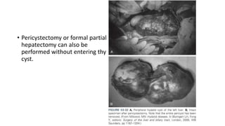 • Pericystectomy or formal partial
hepatectomy can also be
performed without entering thy
cyst.
 
