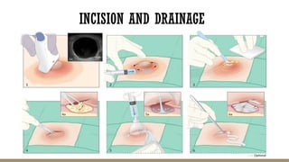 INCISION AND DRAINAGE
 