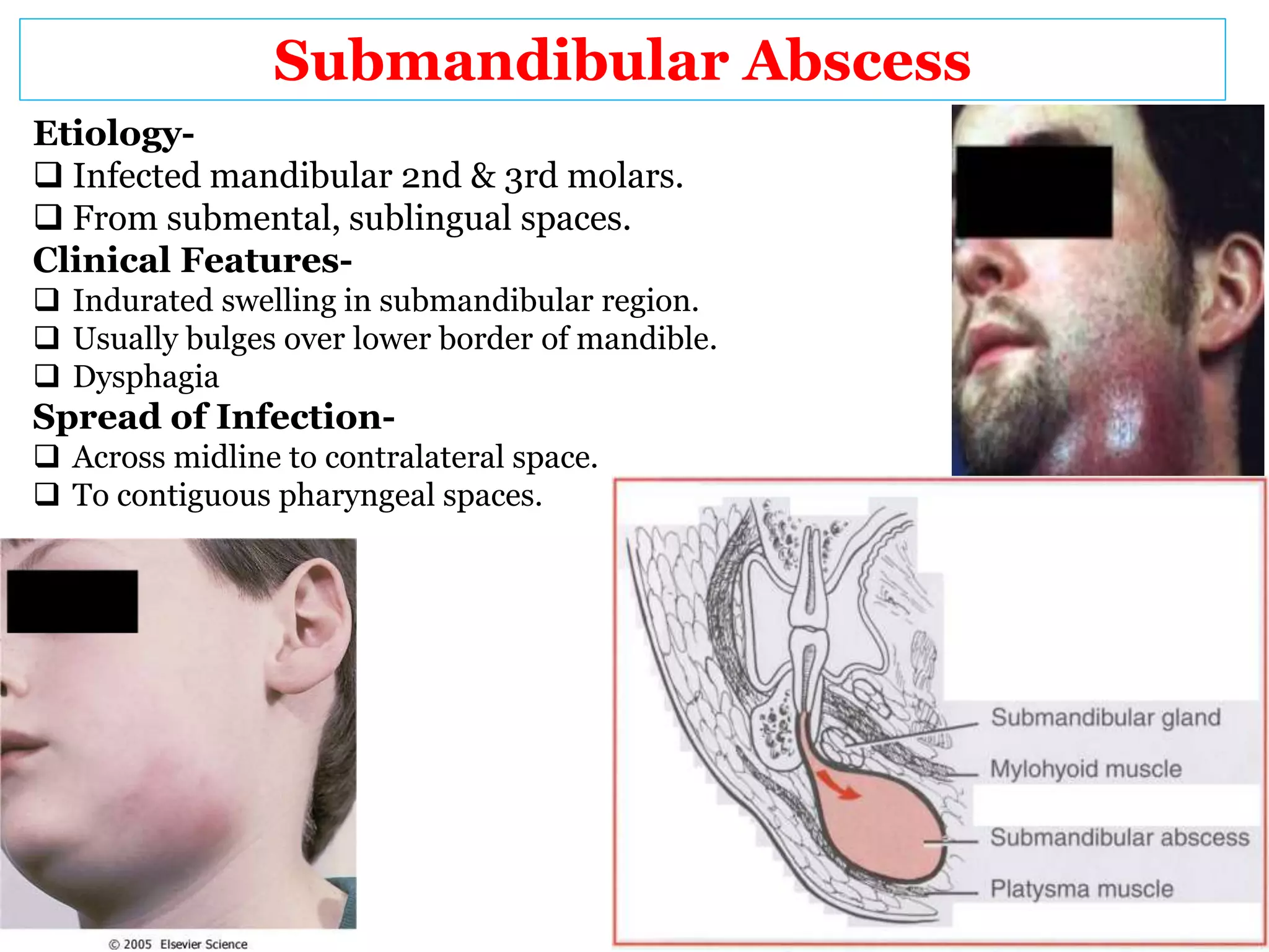 Abscess oral maxillo-presentation | PPTX