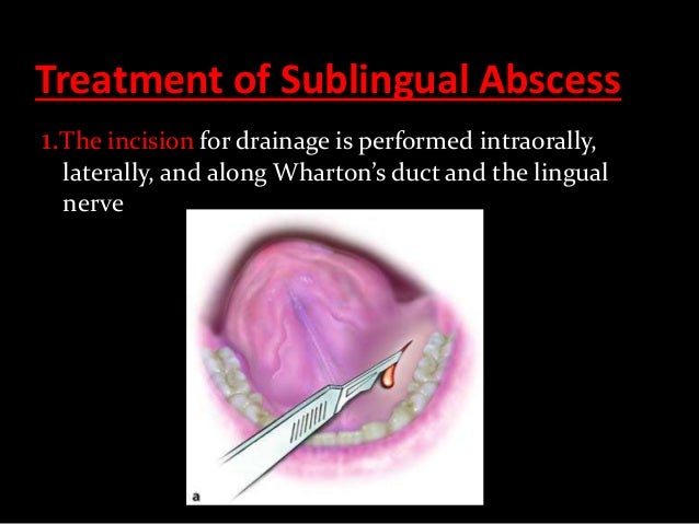 abscess phlegmon incision odontogenic maxillofacial pterygomandibular