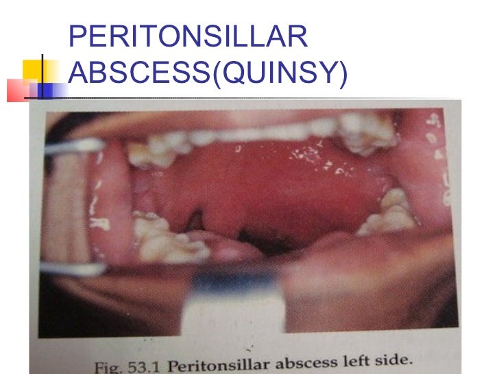 Abscesses in relation to pharynx