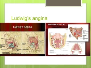 Ludwig’s angina
 