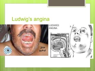 Ludwig’s angina
 