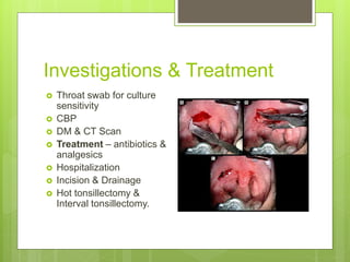 Investigations & Treatment
 Throat swab for culture
sensitivity
 CBP
 DM & CT Scan
 Treatment – antibiotics &
analgesics
 Hospitalization
 Incision & Drainage
 Hot tonsillectomy &
Interval tonsillectomy.
 