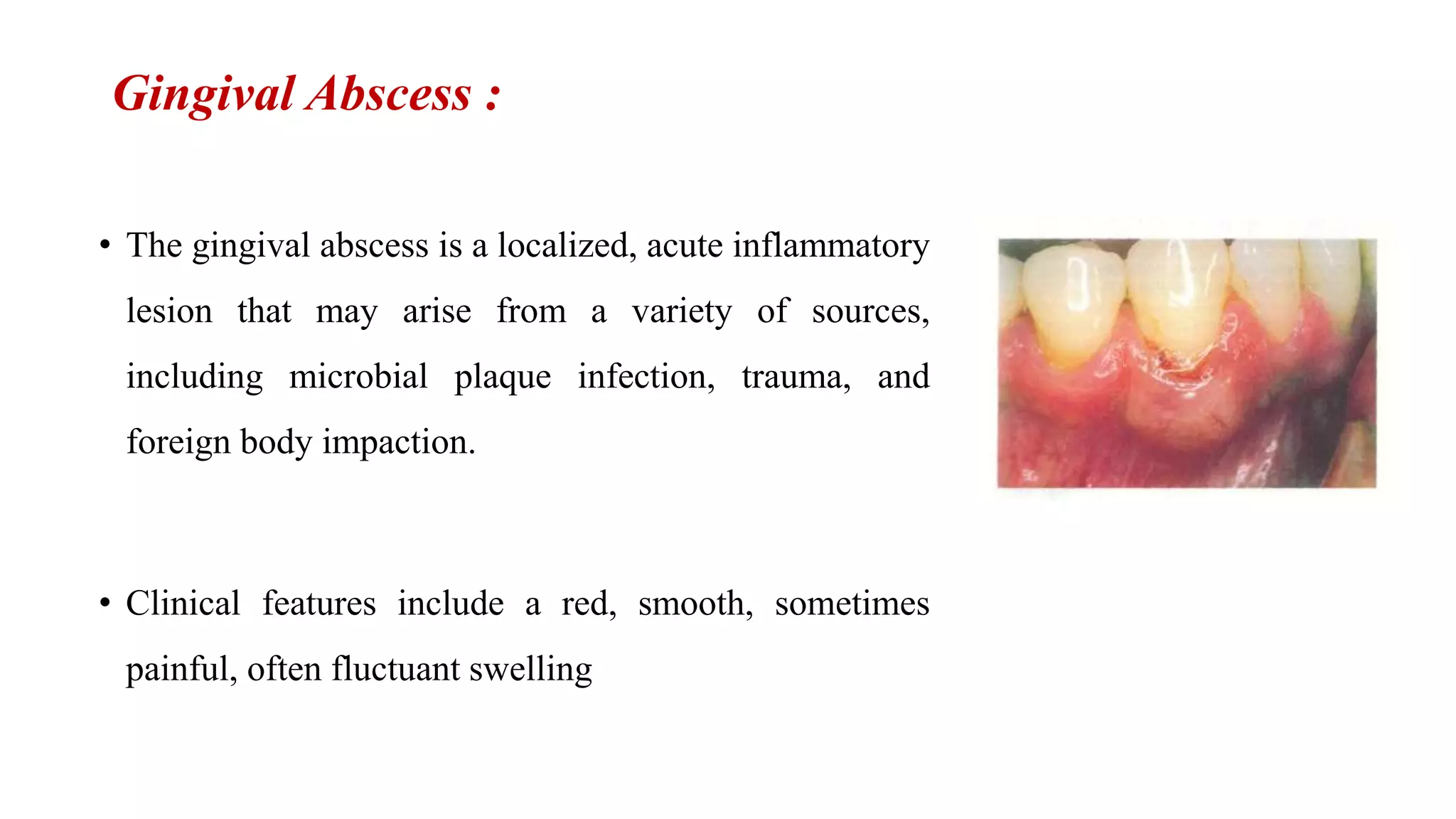 Abscesses Of The Periodontium PPT