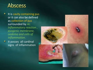 It is cavity containing pus
or it can also be defined
as collection of pus
surrounded by Ac.
Inflammatory reaction ,
pyogenic membrane,
oedema and cells of
inflammation.
It posses all cardinal
signs of inflammation
 
