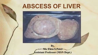 ABSCESS OF LIVER
By,
Ms. Ekta S Patel
Assistant Professor (MSN Dept.)
 