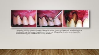 Abscess of periodontium | PPTX