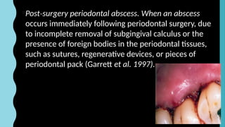 Periodontal abscess, abscess of periodontium | PPTX