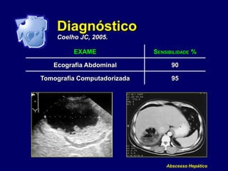 Abscesso Hepático
Diagnóstico
Coelho JC, 2005.
EXAME SENSIBILIDADE %
Ecografia Abdominal 90
Tomografia Computadorizada 95
 