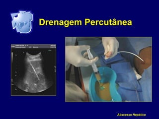 Drenagem Percutânea
Abscesso Hepático
 