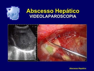 Abscesso Hepático
Abscesso Hepático
VIDEOLAPAROSCOPIA
 