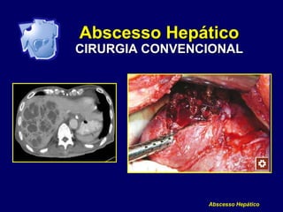 Abscesso Hepático
Abscesso Hepático
CIRURGIA CONVENCIONAL
 