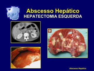 Abscesso Hepático
Abscesso Hepático
HEPATECTOMIA ESQUERDA
 