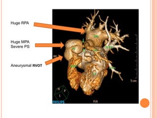 Huge RPA 
Huge MPA 
Severe PS 
Aneurysmal RVOT 
 