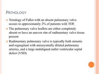 PATHOLOGY 
 Tetralogy of Fallot with an absent pulmonary valve 
occurs in approximately 2% of patients with TOF. 
 The pulmonary valve leaflets are either completely 
absent or have an uneven rim of rudimentary valve tissue 
present 
 Rudimentary pulmonary valve is typically both stenotic 
and regurgitant with aneurysmally dilated pulmonary 
arteries, and a large malaligned outlet ventricular septal 
defect (VSD) 
 