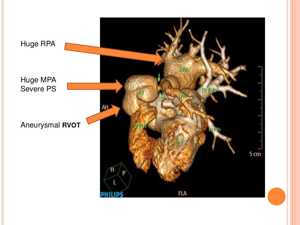 Absent pulmonary valve