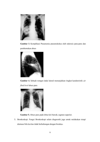 Gambar 3. Komplikasi Pneumonia pneumokokus oleh nekrosis paru-paru dan

      pembentukan abses




      Gambar 4. Sebuah rontgen dada lateral menunjukkan tingkat karakteristik air

      fluid level abses paru




      Gambar 5. Abses paru pada lobus kiri bawah, segmen superior.

5. Bronkoskopi. Fungsi Bronkoskopi selain diagnostik juga untuk melakukan terapi

   drainase bila kavitas tidak berhubungan dengan bronkus.



                                         9
 