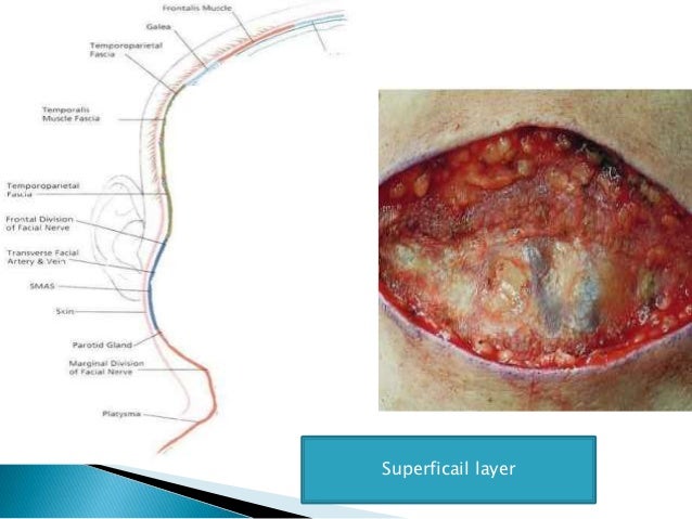 Abses leher dalam Abses leher dalam