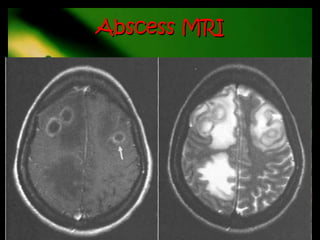 Abscess MRI
 