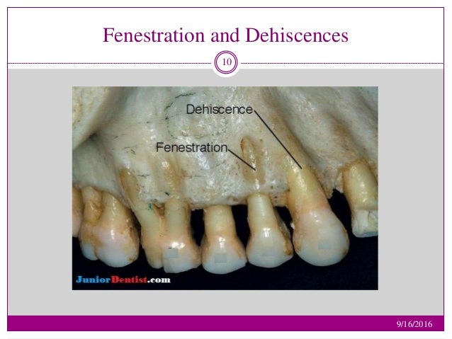 Alveolar Bone