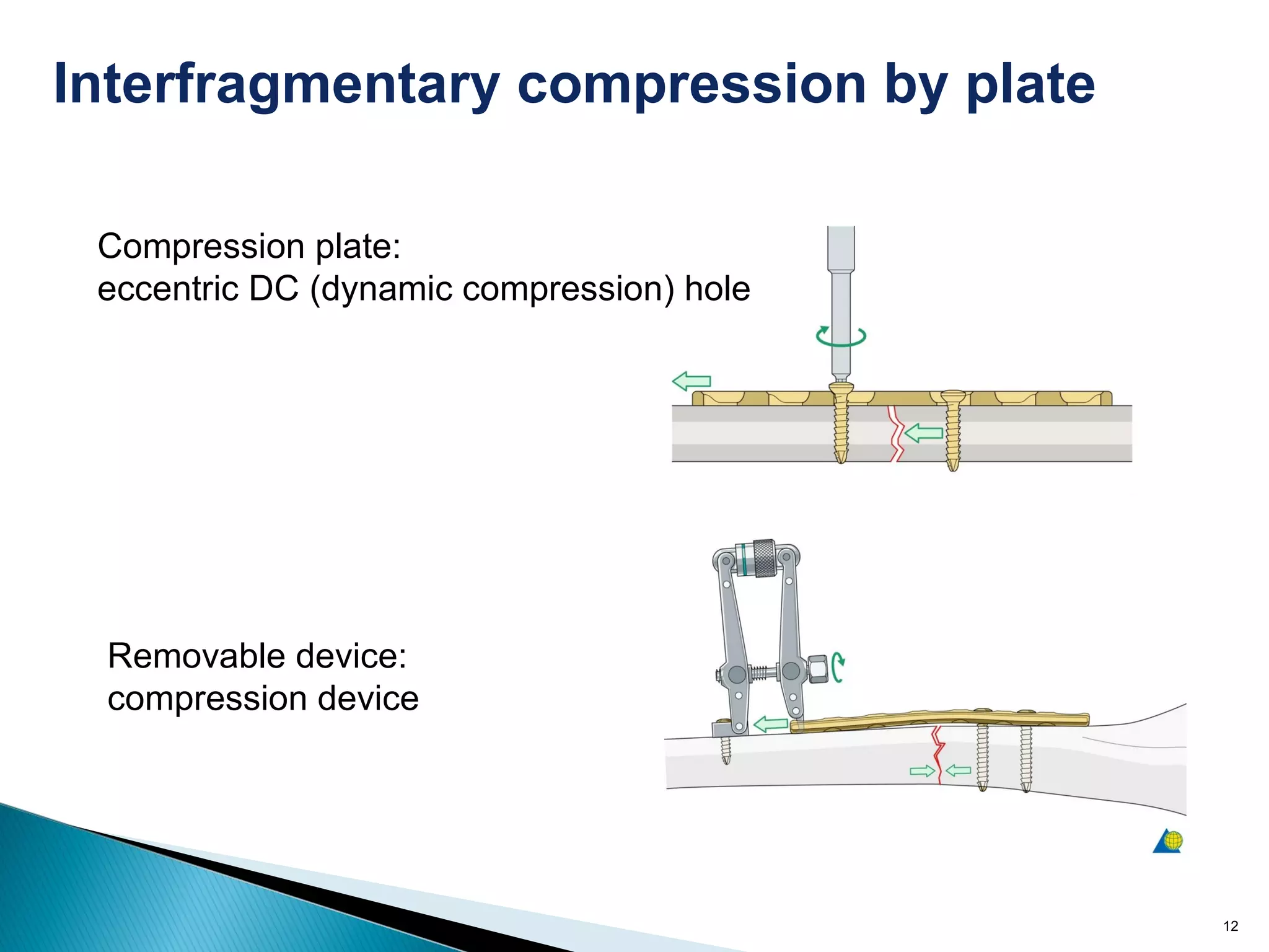 12
Compression plate:
eccentric DC (dynamic compression) hole
Removable device:
compression device
Interfragmentary compression by plate
 
