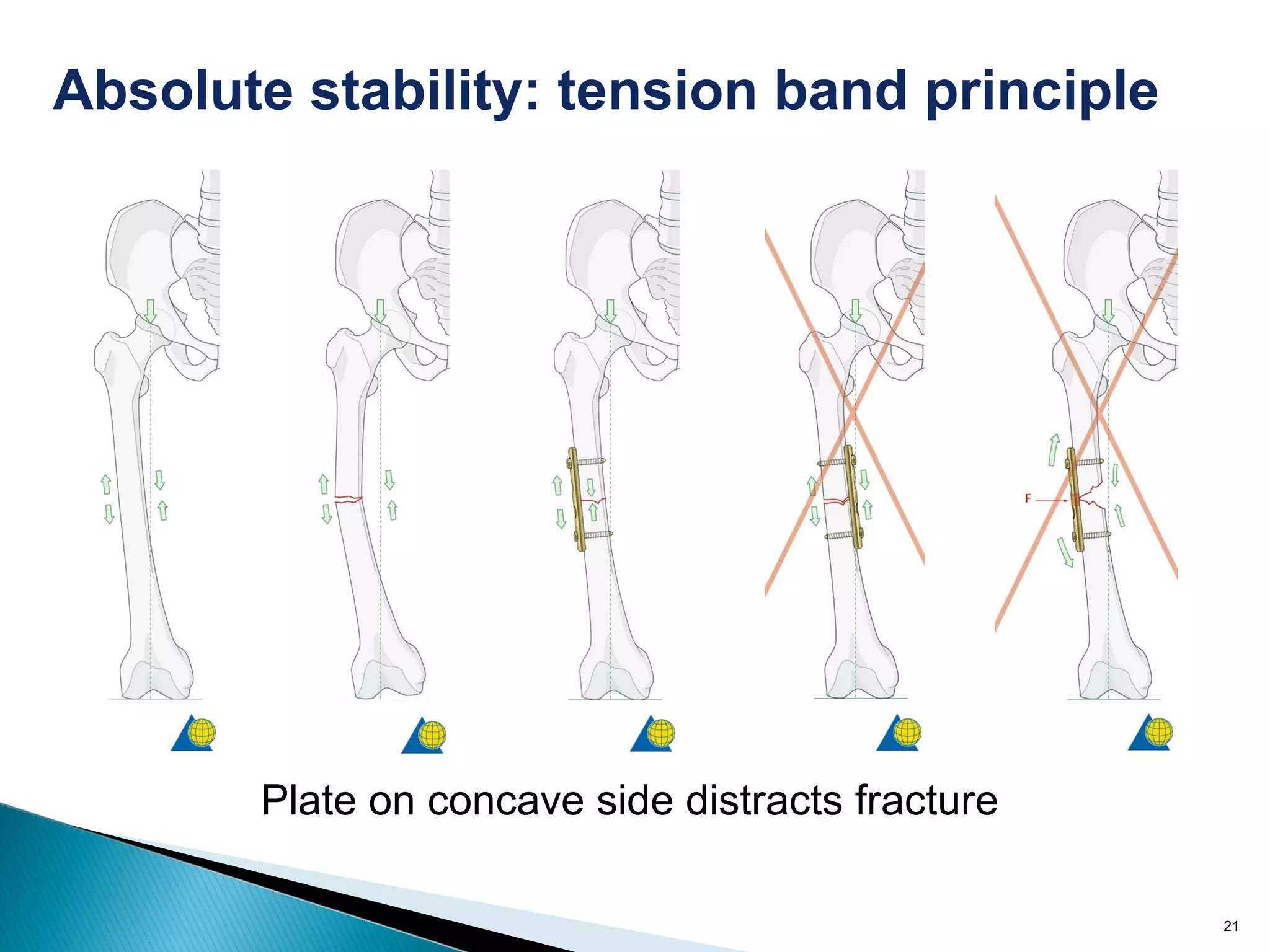 21
Plate on concave side distracts fracture
Absolute stability: tension band principle
 